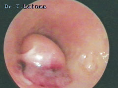 Endometrial polyp on the right uterine horn, that obscures the view of the opening of the right Fallopian tube.